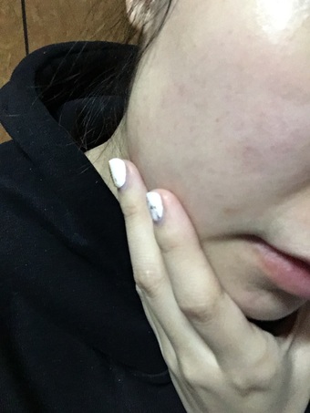 漸轉變成混合偏乾肌，換季時皮膚會變得比較難