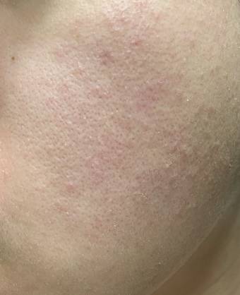 外的精華液，最近因為換季的關係，皮膚狀況超