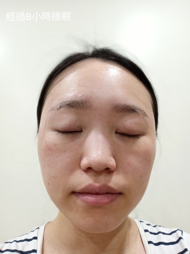 g經過一夜膚況仍穩定