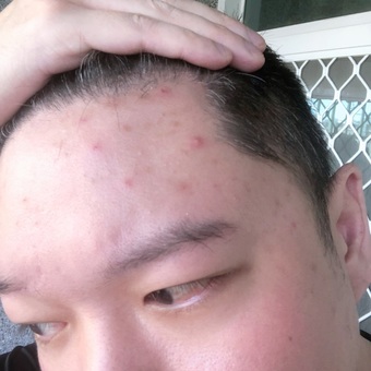 一直延伸到快下巴都有痘痘 一直延伸到快下巴都有痘痘