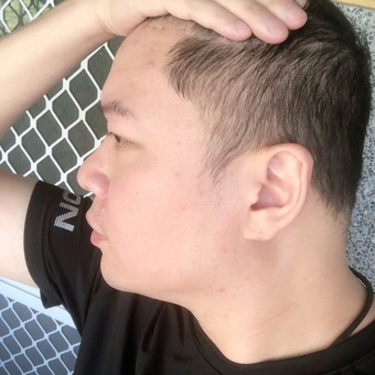 我真的莫名其妙長痘痘 我真的莫名其妙長痘痘
