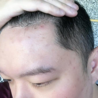 額頭那邊重災區還是有痘痘痕跡 額頭那邊重災區還是有痘痘痕跡
