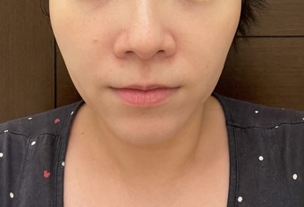 mg▼素顏鼻翼泛紅 mg▼素顏鼻翼泛紅