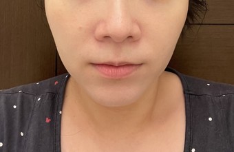 S小燈管後膚色明顯提亮 S小燈管後膚色明顯提亮