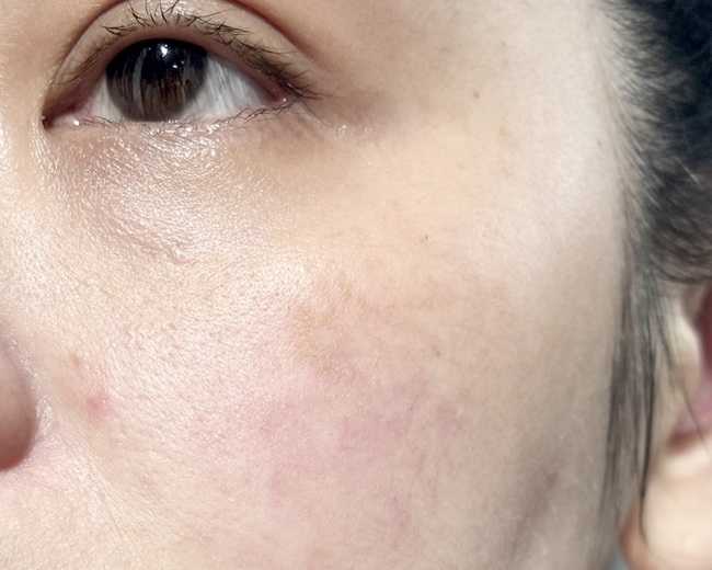 穩定～下巴顆粒也有減少一些些