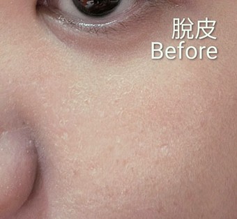 這我試最準糟糕的膚況