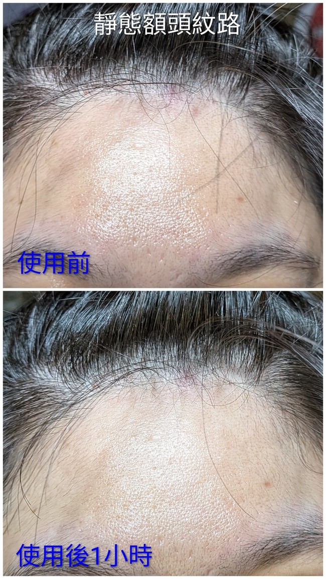 下是靜態額頭使用後小時的改變 下是靜態額頭使用後小時的改變