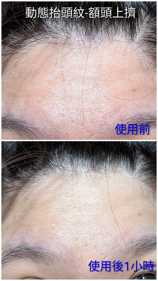 路的使用前後用力擠上抬頭紋 路的使用前後用力擠上抬頭紋