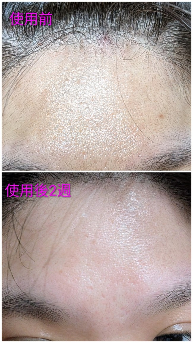 🚨接著是使用週後的靜態額頭紋 🚨接著是使用週後的靜態額頭紋