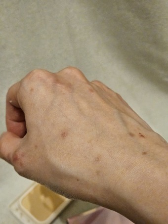 可以很自然地把傷口遮掉 可以很自然地把傷口遮掉